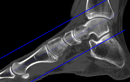 Foot/Forefoot axial reformats