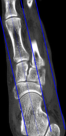Foot/Forefoot sagittal reformats